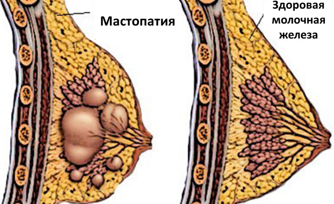 Операция простатэктомия: радикальная и лапароскопическая Prostatit GURU Операция по удалению простаты Частичная или полная простатэктомия
