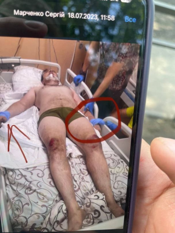 Друзі публікують фото, як медики прив'язали до ліжка пораненого військового / Фото: Аліна Іцелєва / © 