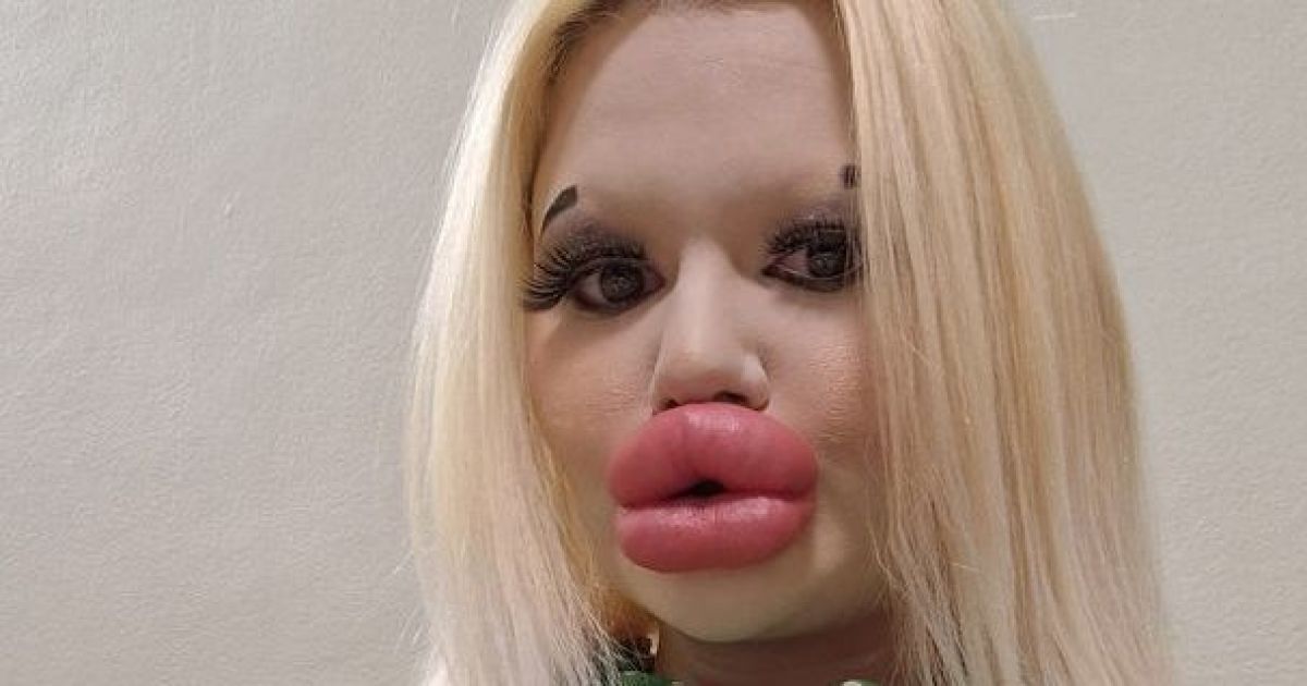 Жінка з найбільшими у світі губами і далі робитиме ін'єкції: "Хочу знайти кохання"