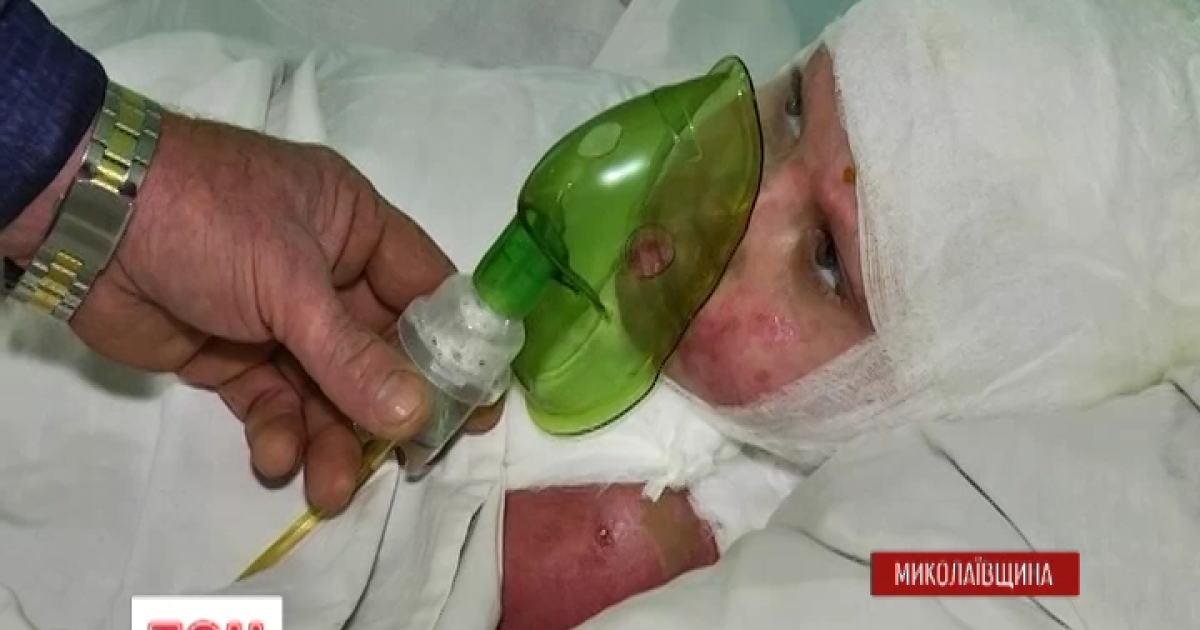 Саша получил 85% ожогов тела