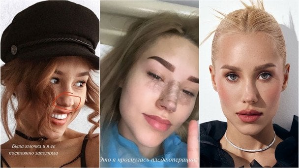 Даша Квіткова: фото до та після ринопластики / © instagram.com/kvittkova
