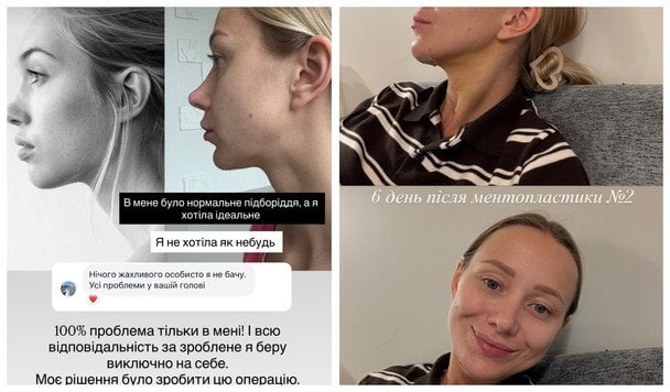 Катерина Реп'яхова: фото до та після ментопластики / © instagram.com/repyahovakate