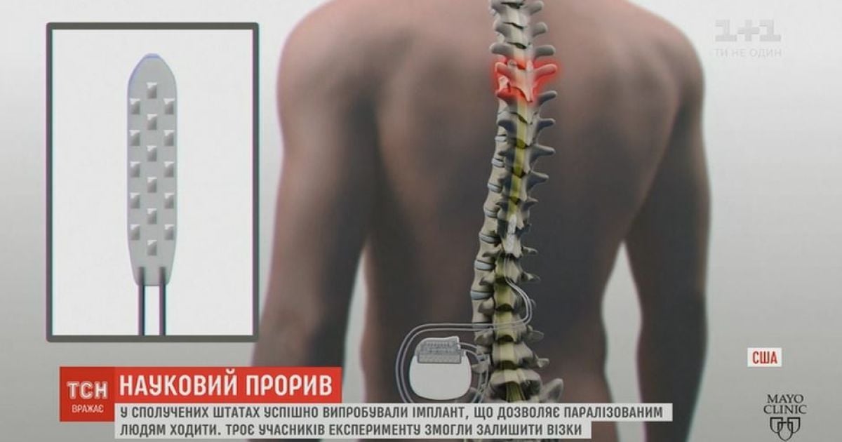 Научный прорыв: В США новейший имплант позволяет парализованным людям ходить