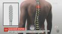 Научный прорыв: В США новейший имплант позволяет парализованным людям ходить