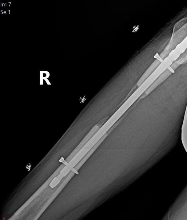 Фото: instagram.com/mrbrokenbonez