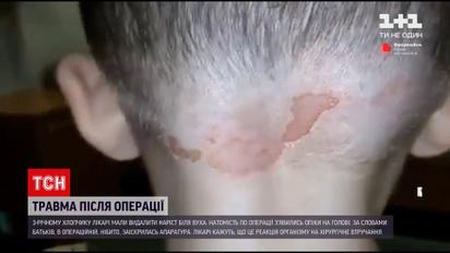 Новини Черкас: 3-річний хлопчик отримав опіки після планової операції