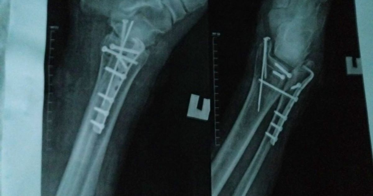 Российские военнослужащие "устраивают" себе переломы конечностей, чтобы не ехать воевать в Украину