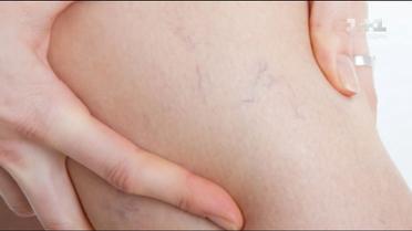 Как предотвратить варикоз