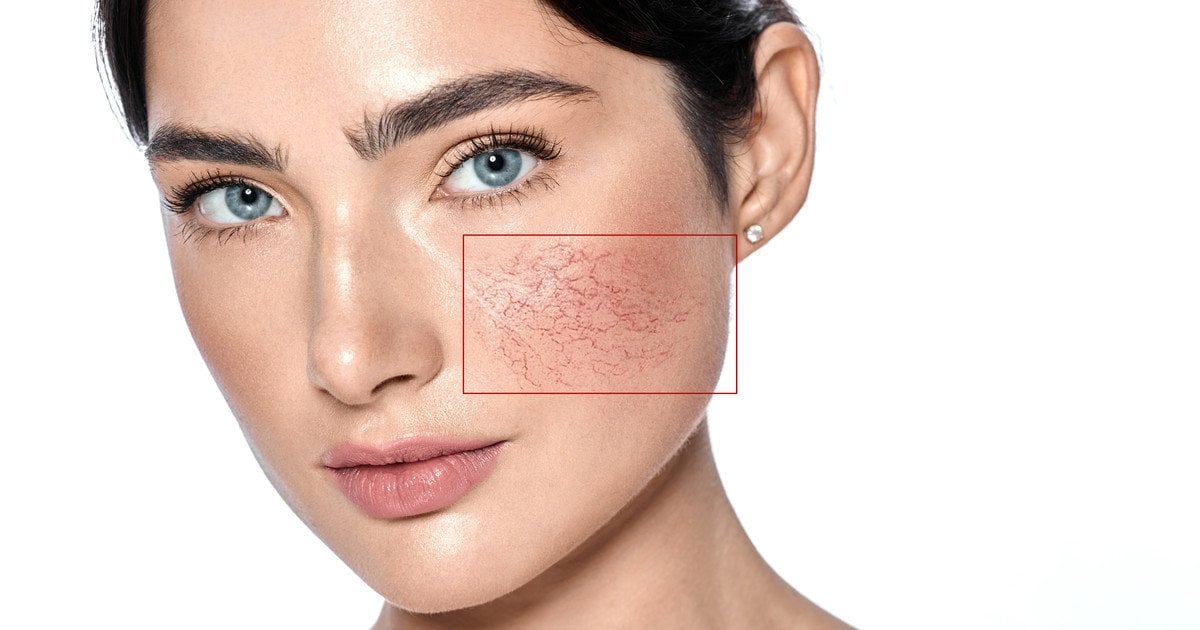 П’ять найпоширеніших міфів про купероз