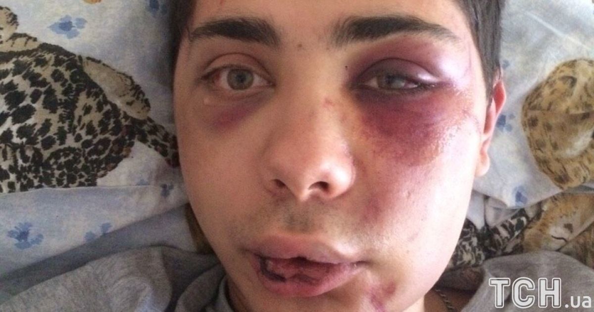 Струс мозку і вибиті зуби. У Сумах хлопець потрапив під гарячу руку охоронцям нічного клубу