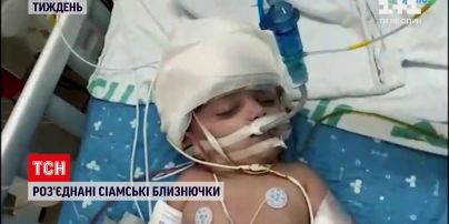 Сиамские близнецы, полет на астероид и Шнобелевская премия - новости с онлайн-трансляции