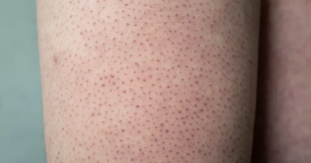 Фолікулярний кератоз