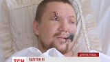 У Дніпропетровську рятують життя 24-річного Капітона Лі, який підірвався на міні