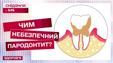 Пародонтит: как предотвратить воспаление и сохранить здоровье десен? – Здоровая улыбка