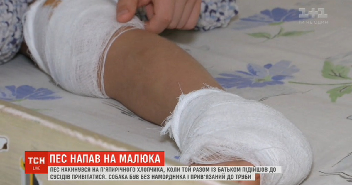 У Києві пес накинувся на п'ятирічного хлопчика: у дитини розірване коліно і п'ята