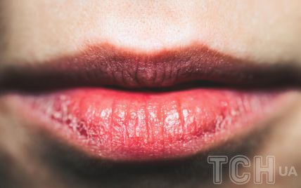 Почему губы трескаются и шелушатся, и что с этим делать? Советы экспертов