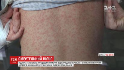 На Одещині від початку місяця від кору померли двоє немовлят