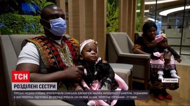 Новини світу: в Туреччині успішно прооперували сіамських близнючок