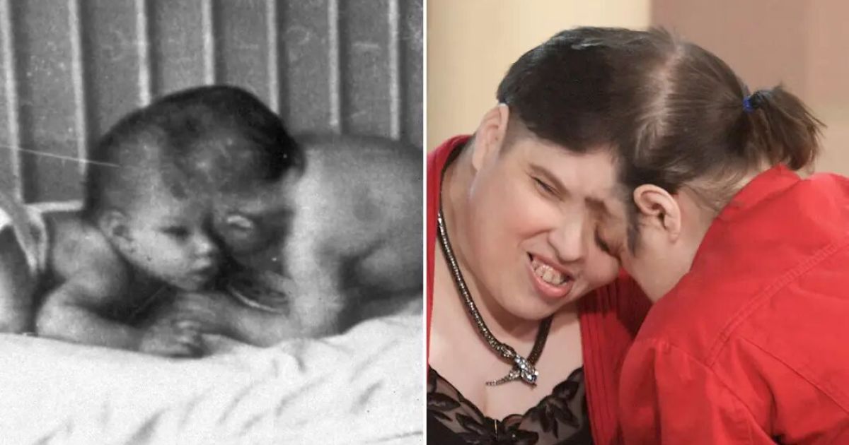 World’s Oldest Conjoined Twins: Laurie and George Chappell Defy Expectations