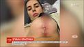 Пацієнтка полтавської клініки пластичної хірургії звинувачує лікарів у спотворенні її грудей