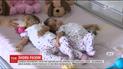 Успешно разъединенные сиамские близнецы не могут жить отдельно