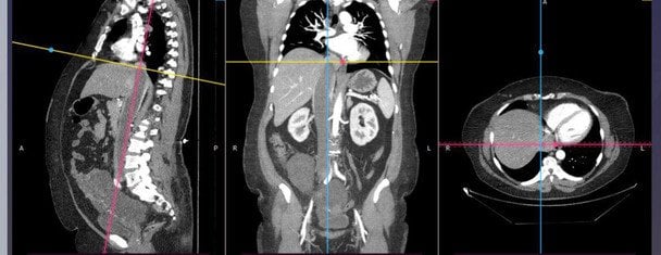 Зображення пухлини, яка дісталася до&nbsp;серця / &copy; Університетська лікарня ЛНМУ імені Данила Галицького