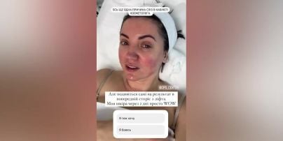 Оля Цыбульская шокировала отечным лицом после косметологической процедуры