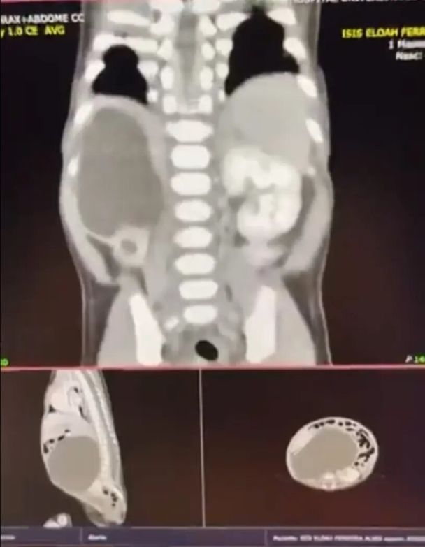 Дитина народилася з чотирма нирками / © Jam Press