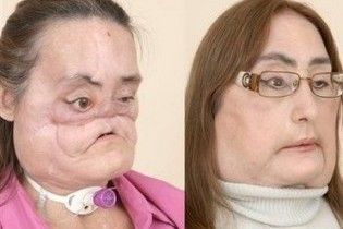 Американка показала громадськості своє пересаджене обличчя