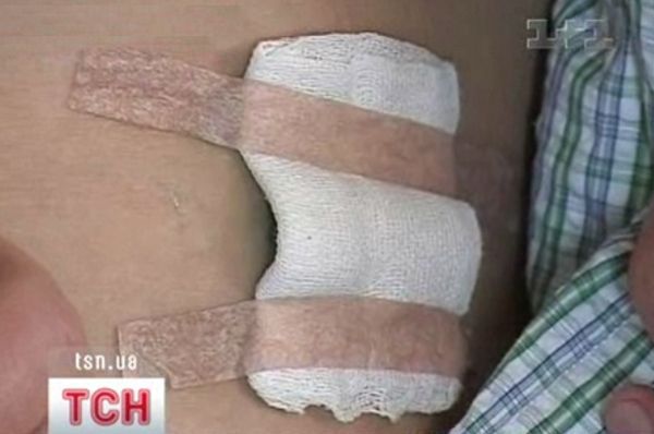 Поранення