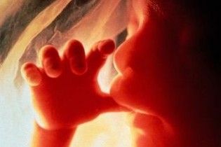 У животі маленької дівчинки знайшли близнюка-паразита