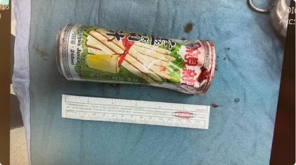 Мужчина вставил себе в анус банку / © Jam Press