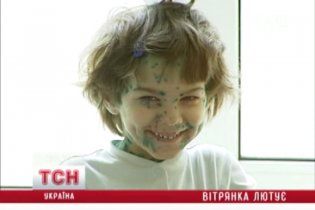 У Києві лютує вітрянка: понад шість тисяч хворих дітей