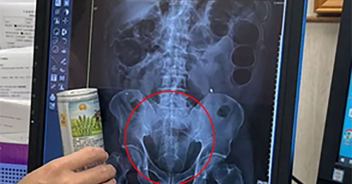 Чоловік вставив собі в анус бляшанку