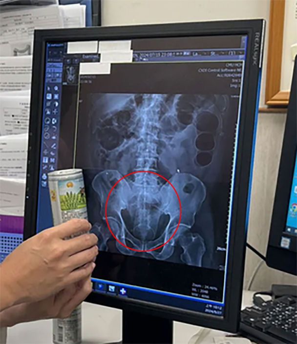 Мужчина вставил себе в анус банку / © Jam Press