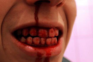 На Донеччині п'яний хуліган відгриз носа відвідувачу кафе