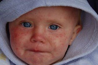 На Україну з Європи насувається епідемія кору