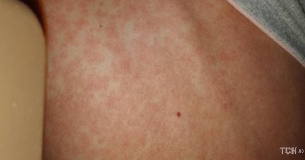 У Львові щодня госпіталізують 25-30 хворих на кір