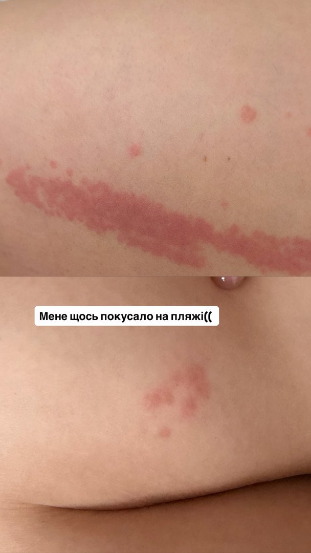 Анна Трінчер пожалілась на висипання на тілі / © instagram.com/annatrincher_official
