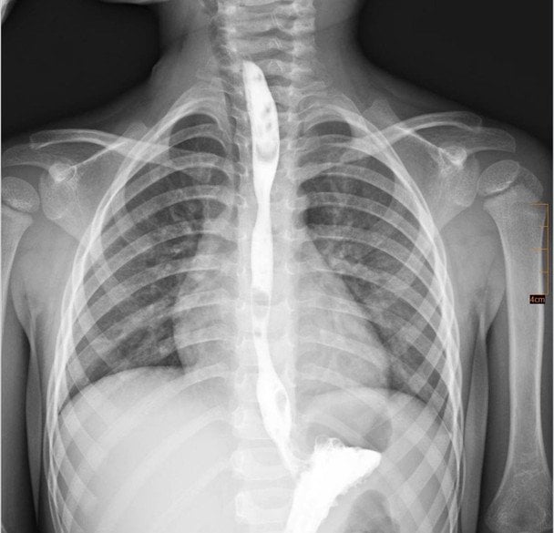 Рентгенобследование пищевода после выздоровления мальчика