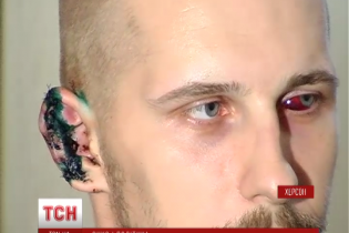 В Херсоне депутат от "Оппоблока" во время драки откусил ухо активисту