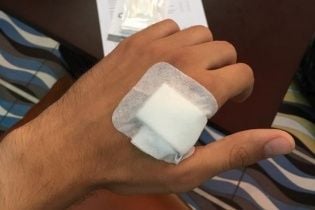 В Одесі двоє добровольців стали "кіборгами" після вшиття під шкіру імпланта