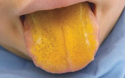 Рідкісне захворювання забарвило язик хлопчика в яскраво-жовтий колір