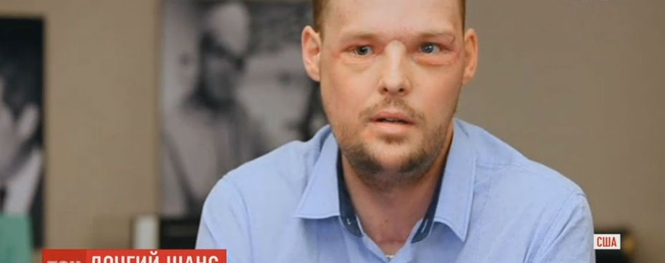 Хирурги в США пересадили лицо мужчине после его неудачного самоубийства