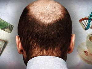 Почему вокруг так много лысых мужчин