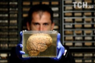 Reuters показало, як виглядають мізки психічно хворих людей