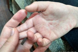 На Одещині стався спалах кору в частині Нацгвардії