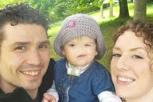 В Великобритании девочка родилась без носа