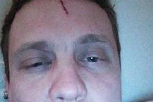 На Київщині побиття депутата від "УКРОПу" спровокувало запеклу дискусію у мерії