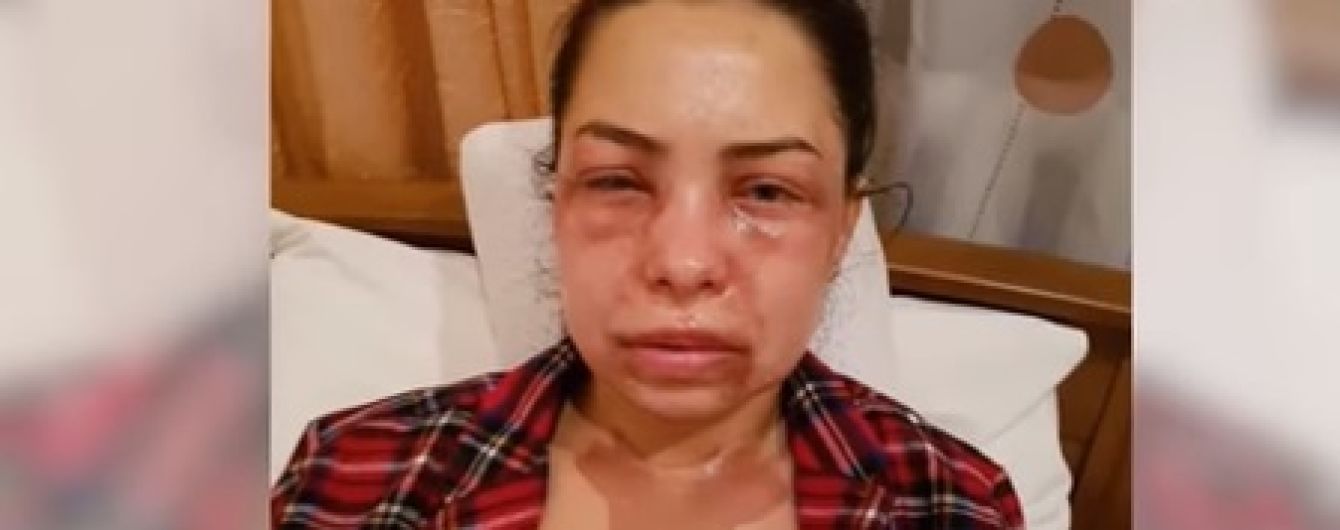 Лікарі рятують зір дружини французького режисера, яку у Дніпрі облили кислотою